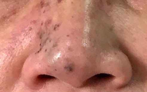 Bị hoại tử mặt do bơm chất làm đầy từ một Spa ảnh 1